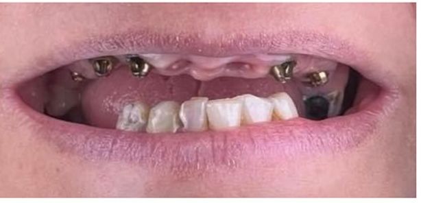 ابتسامة هوليود